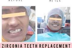before-after-6