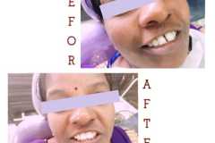 before-after-8