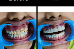 Tooth Discolorization