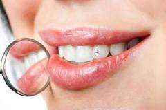 Cosmetic Tooth Jewellery