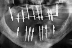 What-are-basal-implants