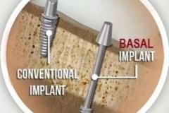 dental-implant-1