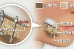 dental-implant-2