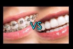 Invisible-aligners-2