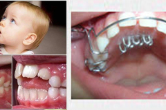 kids-thumb-sucking-2