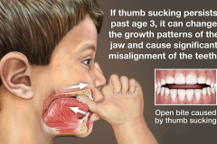 kids-thumb-sucking