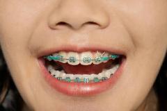 braces-1