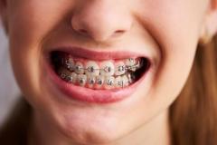 braces-2