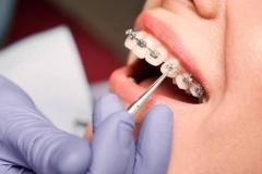 braces-3
