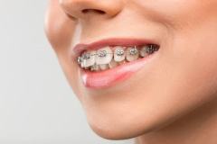 braces-4