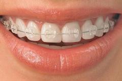 braces-5